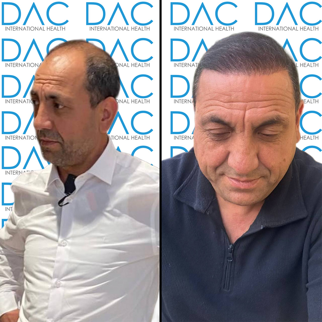 Rezultati Prije i Poslije Transplantacije Kose