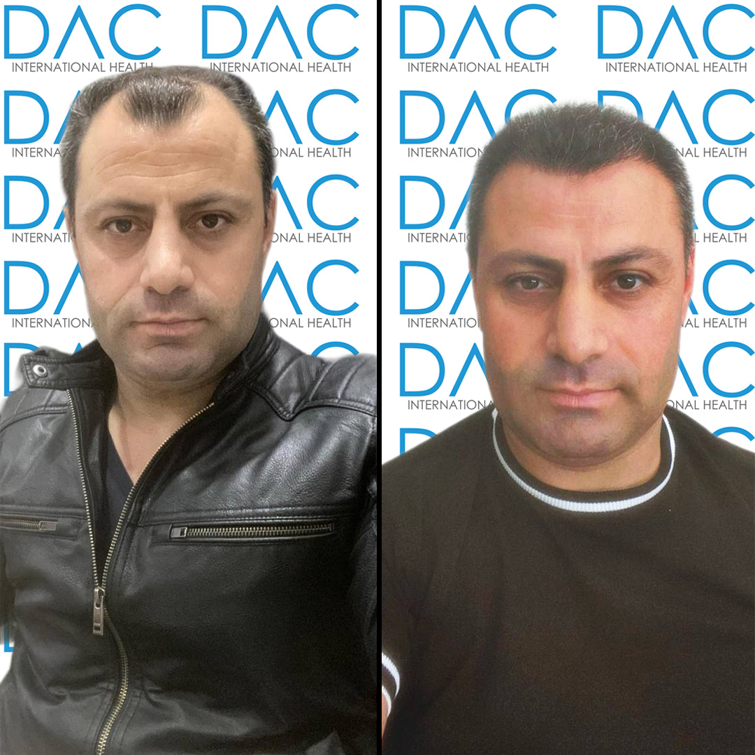 Rezultati Prije i Poslije Transplantacije Kose