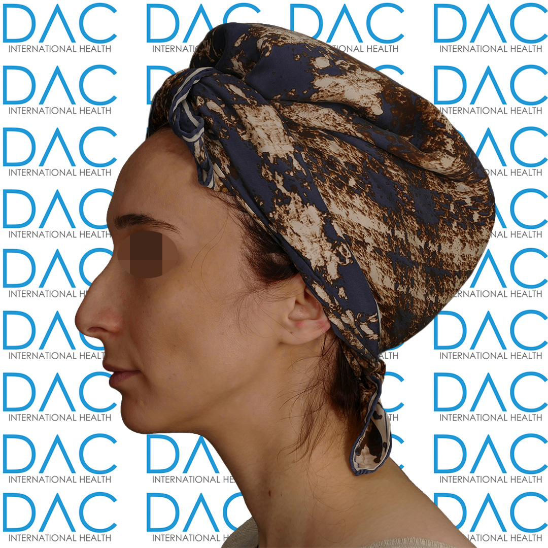 Rezultati Prije i Poslije Rinoplastike