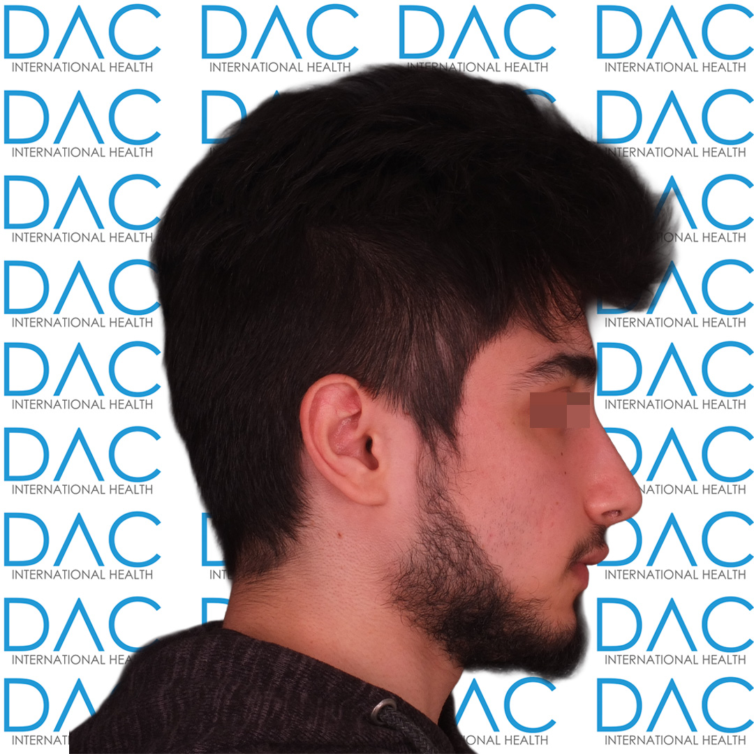 Rezultati Prije i Poslije Rinoplastike